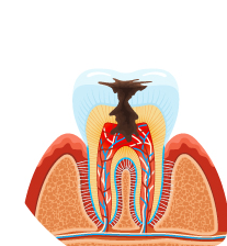 Endodoncia