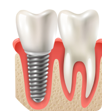 Implantes Dentales