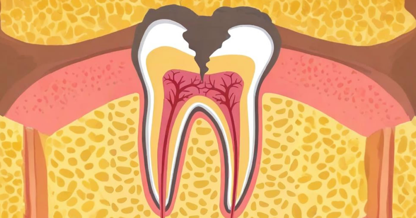 Endodoncia