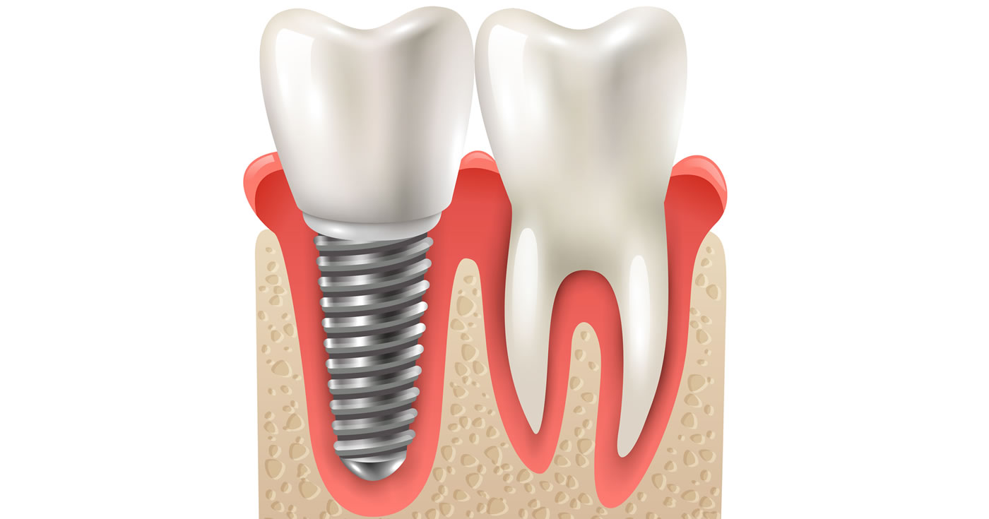 Implantes dentales